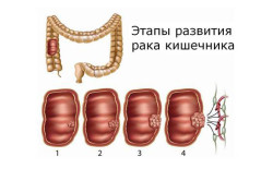 Этапы развития рака кишечника