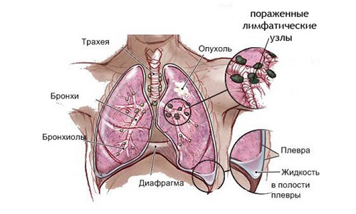 Легочная саркома Легочная саркома