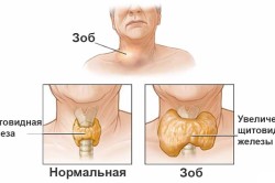 Пример увеличения щитовидной железы (узлы на шее нужно показать врачу)