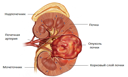 Схема рака почки Схема рака почки