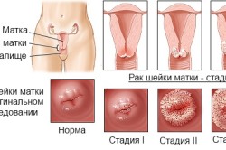 Стадии рака шейки матки