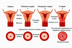 Стадии рака матки