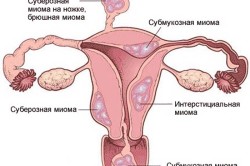 Виды миом матки