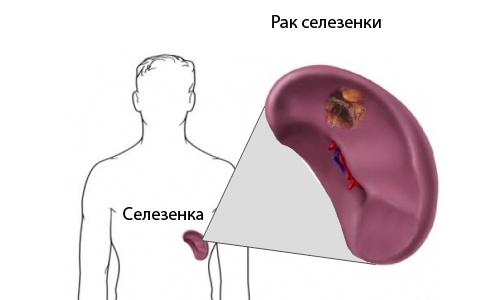 Рак селезенки Рак селезенки