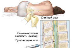 Биопсия костного мозга