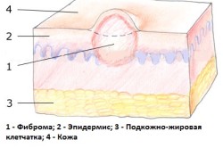 Фиброма тканей