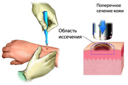 Процесс удаления меланомы