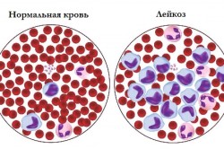 Состав крови при лейкозе