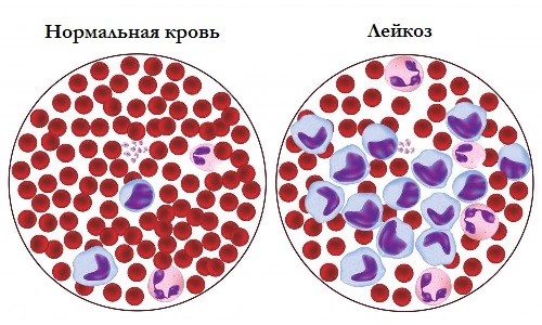 Состав крови при лейкозе Состав крови при лейкозе