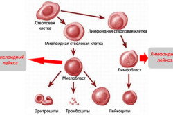 Развитие лейкоза