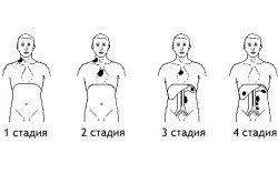 Стадии лимфомы и области поражения