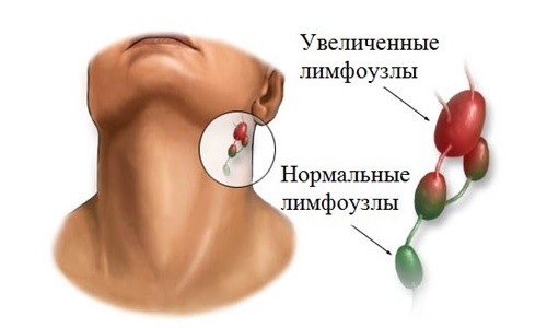 Увеличенные лимфоузлы при лимфоме