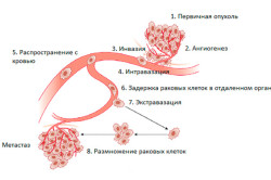 Алгоритм образования метастаз