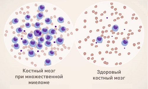 Схема миеломы костей Схема миеломы костей