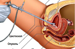 Уретроскопия