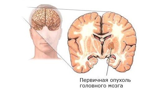 Рак головного мозга