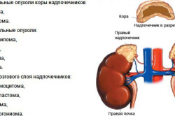 Классификация опухолей надпочечников