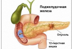 Признаки рака поджелудочной железы