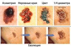 Признаки злокачественной родинки и ее эволюция