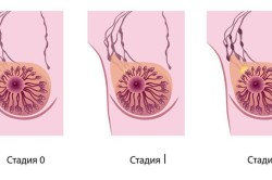 Первые стадии рака груди