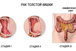 Стадии рака толстой кишки