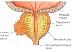 Рак простаты