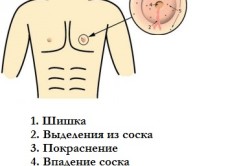 Признаки рака молочной железы у мужчин