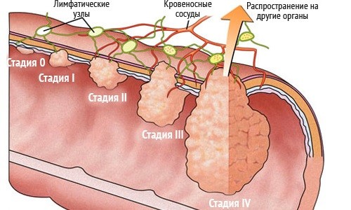 Стадии рака прямой кишки