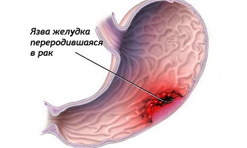 Рак желудка Рак желудка