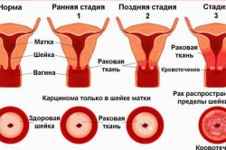 Стадии рака матки
