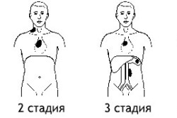 Стадии лимфогранулематоза и области поражения Стадии лимфогранулематоза и области поражения