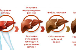 Стадии рака печени