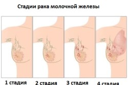 Стадии рака молочной железы