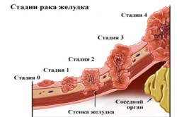 Стадии рака желудка