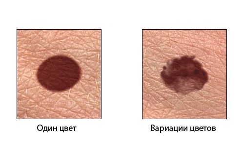 Внешний вид меланомы Внешний вид меланомы