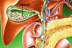 Камни в желчном пузыре