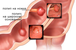 Полипы в прямой кишке