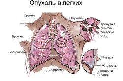 Рак легких
