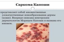 Саркома Капоши