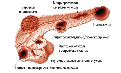 Варианты кистозных образований желудка Варианты кистозных образований желудка
