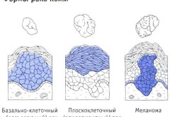 Формы рака кожи