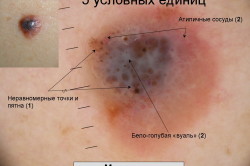 Внешние признаки меланомы