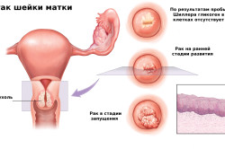 Рак шейки матки