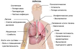 Симптомы лейкоза