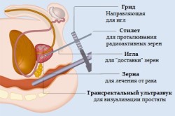 Брахитерапия при раке простаты Брахитерапия при раке простаты