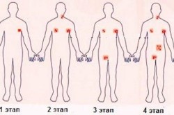 Этапы лимфомы Ходжкина