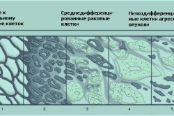 Развитие рака предстательной железы по Глисону