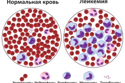 Кровь здорового человека и больного лейкемией