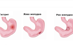 Основные заболевания желудка