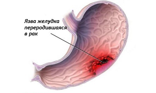 Рак желудка, переродившийся из язвы